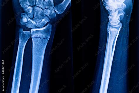 Radiography examination of radius fracture. X-ray human arm. X-ray of ...