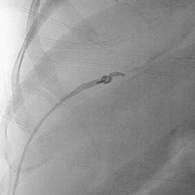 Fluoroscopic Spot Image Showing Closure Of Percutaneous Track Using