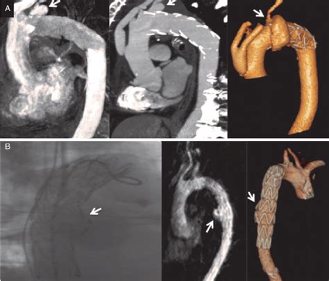 Images Illustrate The Detection Of Endoleaks A Type 2 Endoleak Via