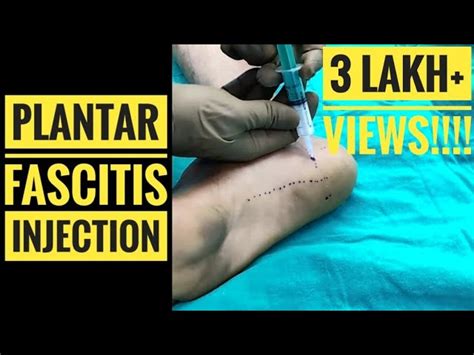 Plantar Fasciitis Injection Technique