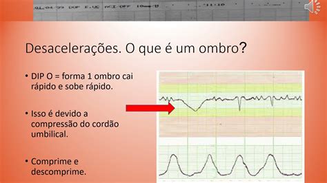 Revis O Do Exame Cardiotocografia Fetal Cardiotocografiafetal Youtube