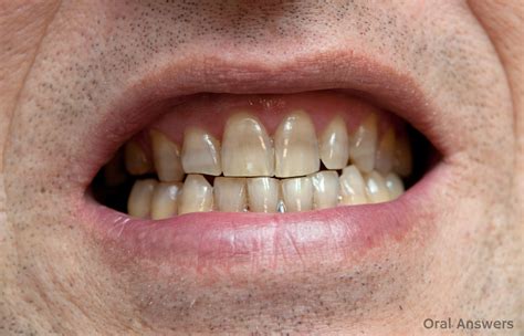 Tetracycline Tooth Staining Its Cause Prevention And Treatment Oral