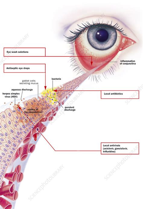 Infectious Conjunctivitis Stock Image C049 2343 Science Photo Library