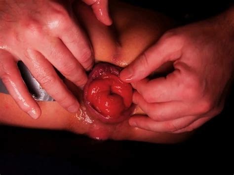 Anal Collapse Booty Naked Wife Cometodaddyg Loose Her Epic Anal Prolapse Really Close Up