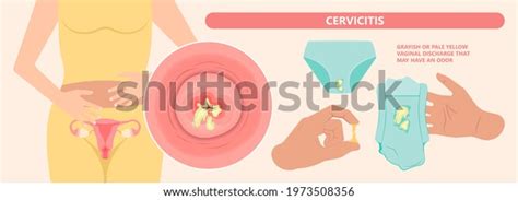 Douche Vagina Odor Clean Blood Flora Stock Vector Royalty Free