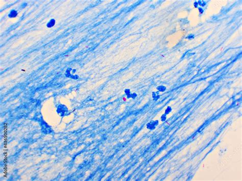 Mycobacterium Tuberculosis Positive Small Red Rod In Sputum Smear