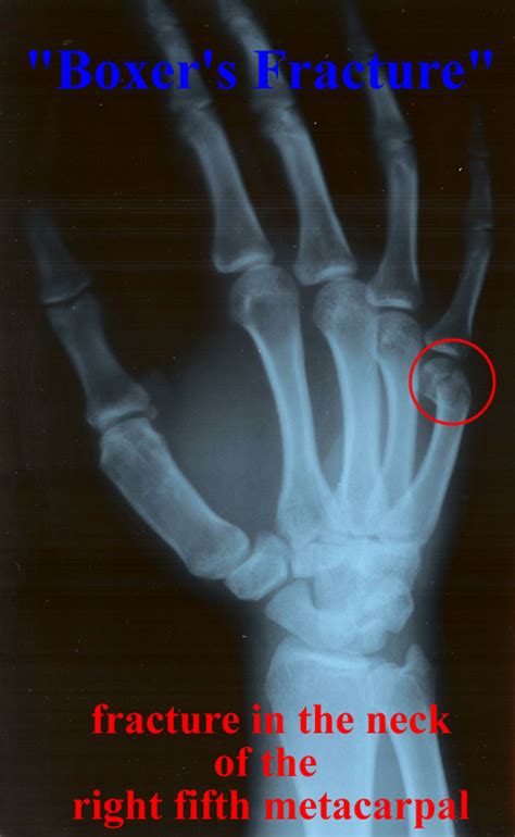 CasesBlog - Medical and Health Blog: Boxer's Fracture