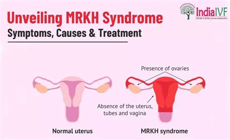 Unveiling MRKH Syndrome Symptoms Causes Treatment At India IVF