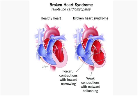 Kuwait groundbreaking research unravels broken heart syndrome | Kuwait