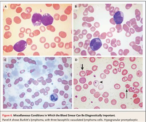 Lead Poisoning Smear