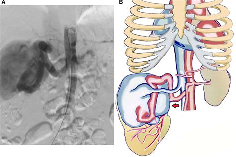 Dialysis Fistula Diagram