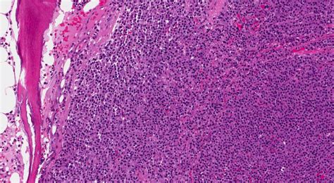 plasma cell myeloma  bone ottawa atlas  pathology