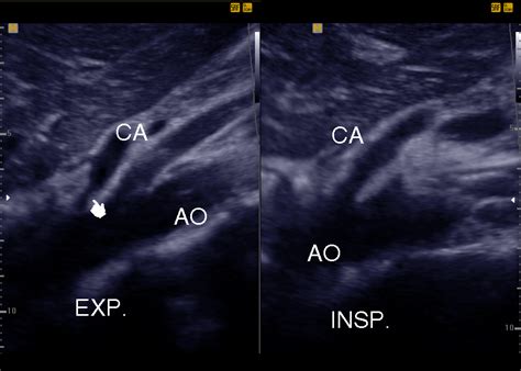 Evaluation of Asymptomatic Patients with Median Arcuate Ligament ...