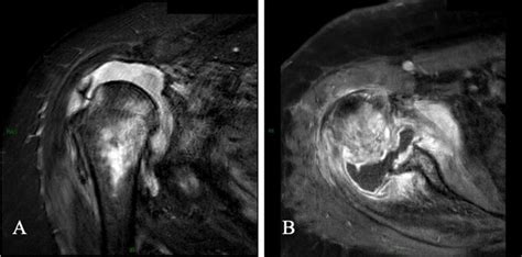 mri  large joint effusion erosive bony   humerus
