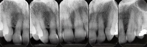 Upper Periodontal X-rays Stock Image - Image: 7059811