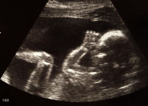 What is a Fetal Ultrasound? (with pictures)