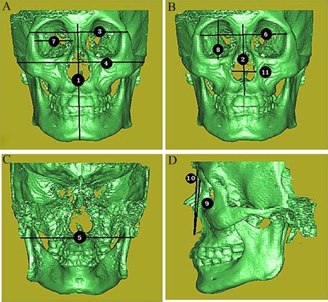 Sex Determination Based On Features Of The Craniofacial Bones In A