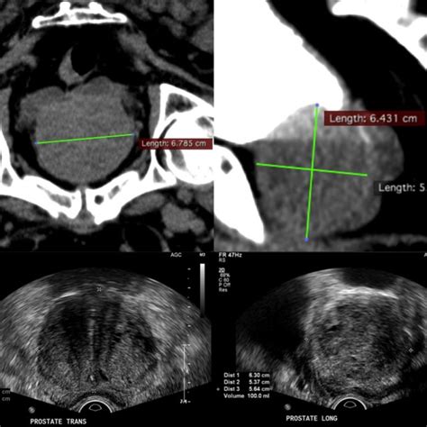 Ct V Mri Comparison Imaging Of Prostate Volume Measurements Using Ct Download Scientific