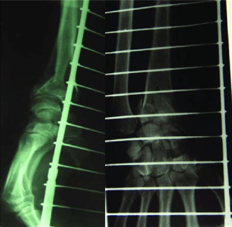 A Years Old Man With Type C Distal Radial Fracture Due To Falling