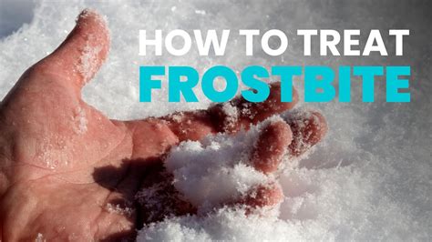 How To Treat Frostbite Youtube