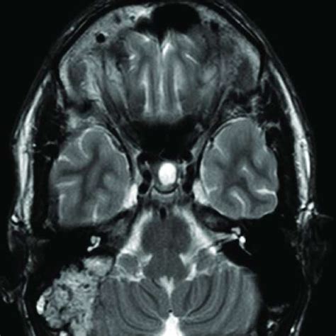 A Complete Guide To Temporal Bone Uses Preparation Procedure And