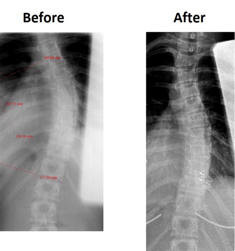 Scoliosis Treatment Results Strauss Scoliosis Correction