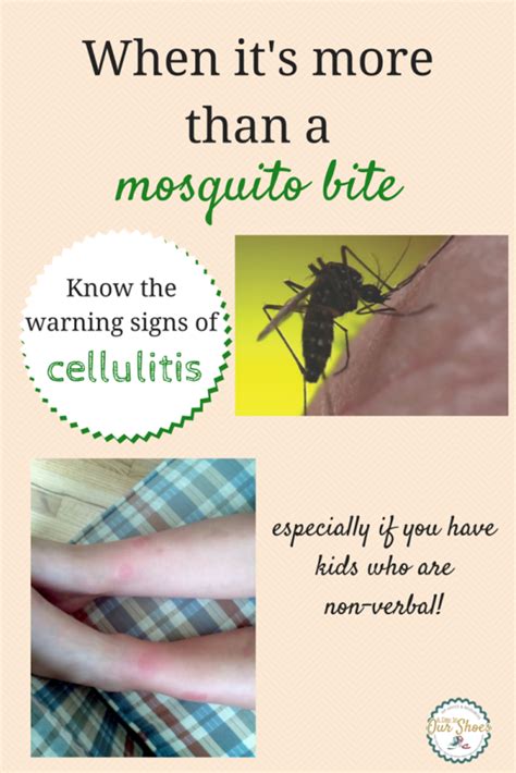 Best Of How To Treat Mosquito Bite Blisters Insectza