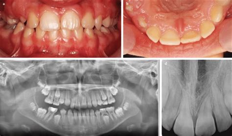 A B Intraoral Photography At Th Month C D Panoramic Radiograph