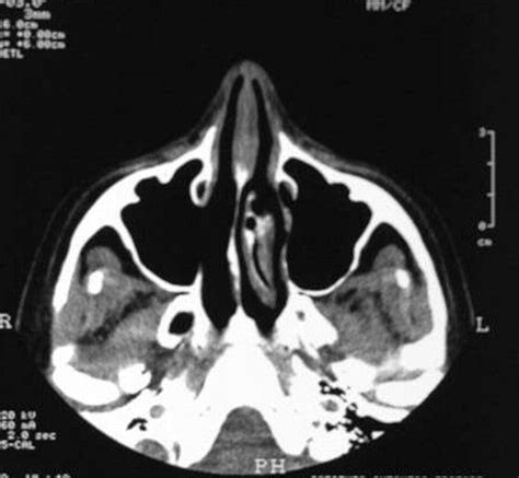 Endoscopic Surgical Treatment Of Chronic Maxillary Sinusitis Of Dental