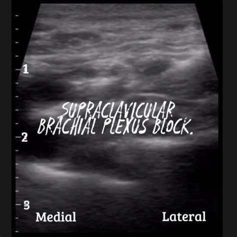 Supraclavicular Brachial Plexus Block — Baby Blocks