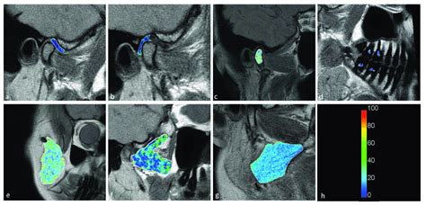 Short T2 Maps Obtained For The A Disk B Retrodiscal Tissue C