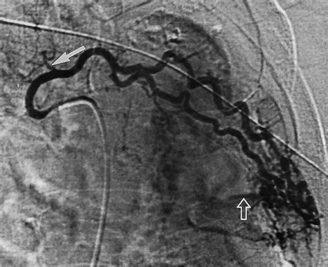 Bronchial And Nonbronchial Systemic Artery Embolization For Life