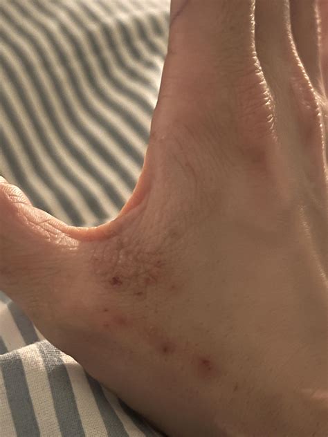 Is This Scabies Itchy Rash Here For A Week Or So And Random Spots All