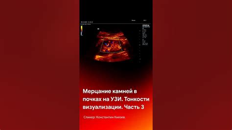 Мерцание камней в почках на УЗИ. Как найти камни в почках #short # ...