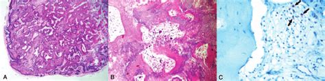 A Histopathological Study Shows A Well Circumscribed Nodular Tumor