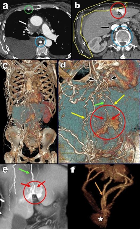 Axial A B Views Of Contrast Enhanced Thoraco Abdominal Computed