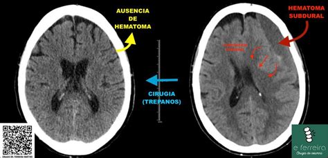 HEMATOMA SUBDURAL CRÓNICO Dr Edgar Ferreira