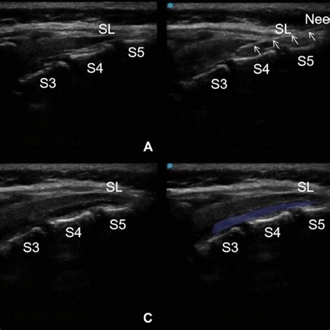 Procedure Of Ultrasound Guided Continuous Sacral Block A The