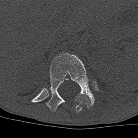 Osteoblastoma | Radiology Case | Radiopaedia.org | Radiology, 7 year olds, Case