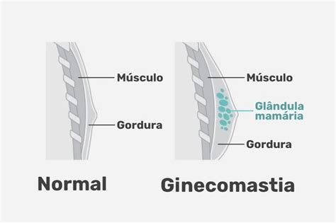Ginecomastia O Que É - Ginecomastia: o que é, sintomas, causas, tipos e tratamento - Tua Saúde