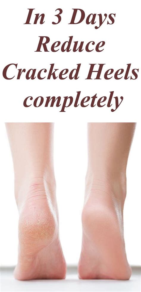 how to fix extremely cracked heels