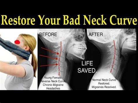 Restore Your Bad Neck Curve With A Simple Towel Dr Alan Mandell D C