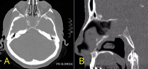 Brain Ct A Axial Scans B Sagittal Scans Showing The Missing Vomer