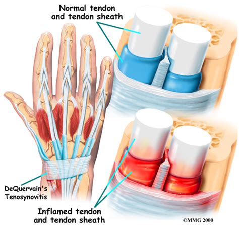 De Quervain's tenosynovitis | 🩺Singapore Sports & Orthopaedic Surgeon