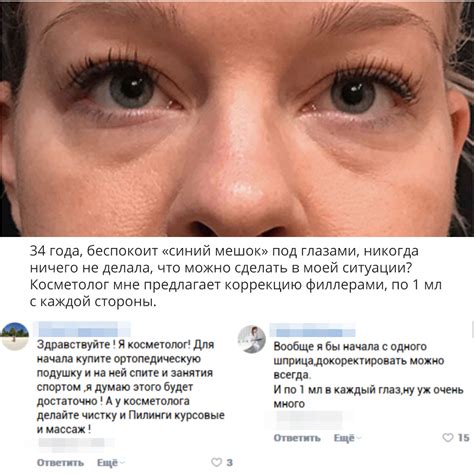Как избавиться от мешков под глазами: эффективные способы >> Глаза ...