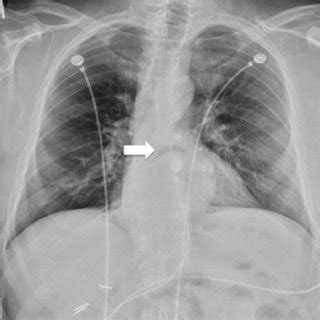 Ct Of The Chest Demonstrating An Intrathoracic Stomach Due To A Large