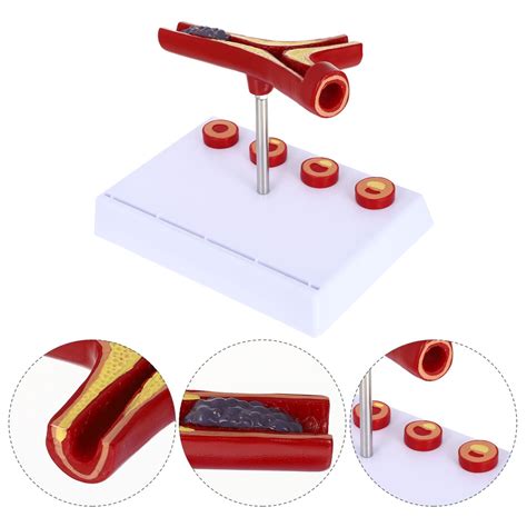 Atherosclerosis Model Human Atherosclerosis Model Body Cardiovascular