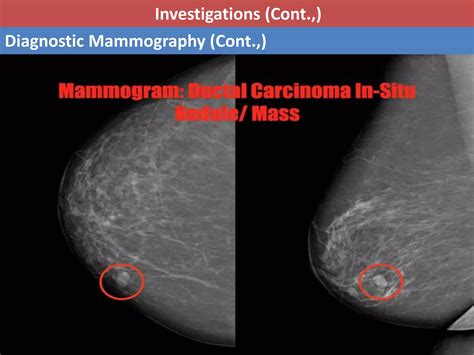 Ductal Carcinoma In Situ Dcis Ppt