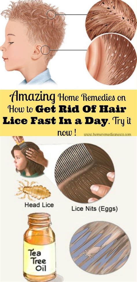 7 Effective Permanent Head Lice Home Remedies In One Day Hair Lice