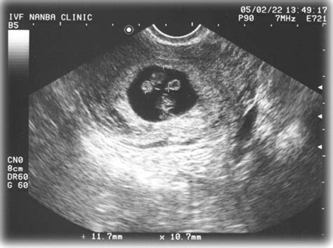 7 Week Sonograms Hiccups Pregnancy